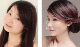 嘴整形图片,嘴整形术后美丽蜕变记